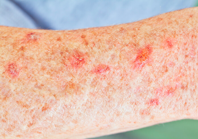 dry scaly arm diagnosed at an AK Dermatology clinic