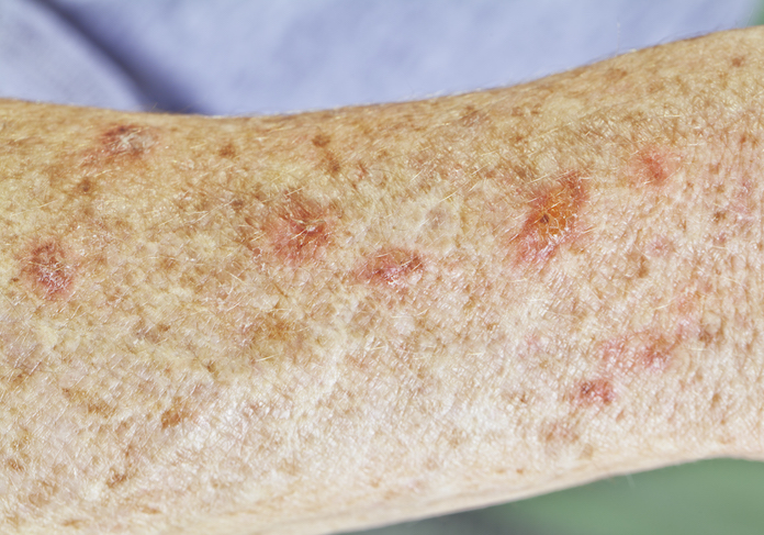 Apotheco - Actinic Keratosis skin cancer