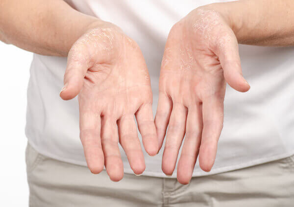 Symptoms of Psoriasis on hands - get the treatment you need from a Psoriasis pharmacy