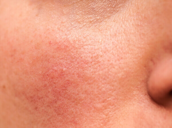 face with Rosacea - this requires Rosacea treatment