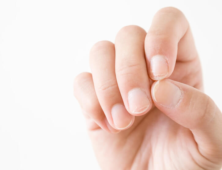 Fungal Nail Infections