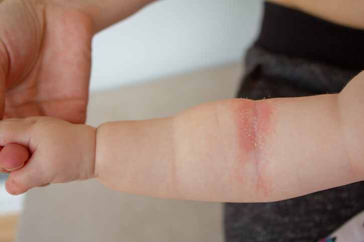 Apotheco Atopic Dermatitis - Baby's arm with Atopic Dermatitis