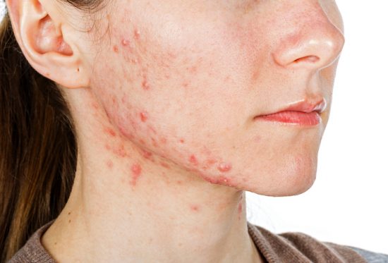 What triggers Acne? Our acne pharmacy has solutions to pimples like these