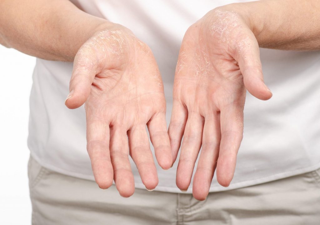 irritant contact dermatitis