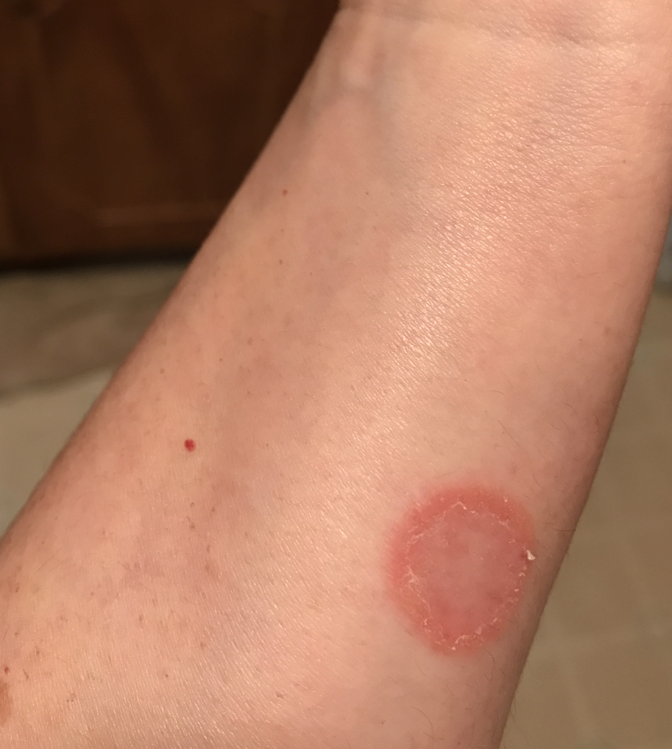 Ringworm Image