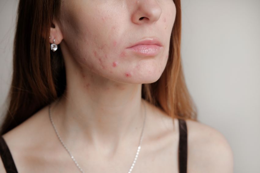 Prescription Adult Acne Treatments