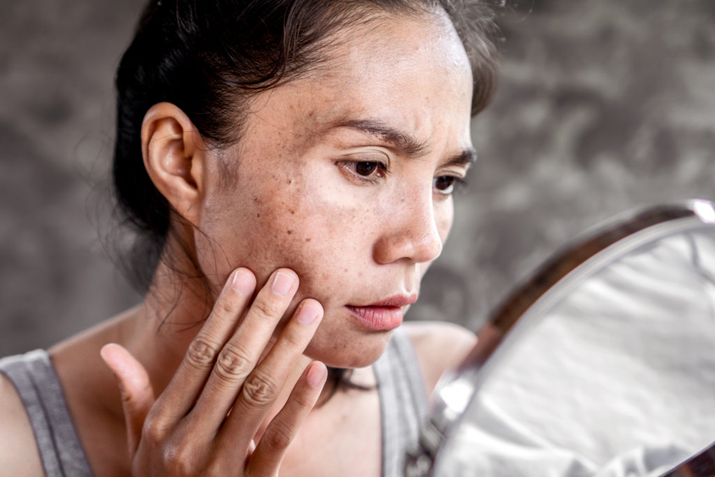How To Get Rid Of Hyperpigmentation Acne – SkinKraft