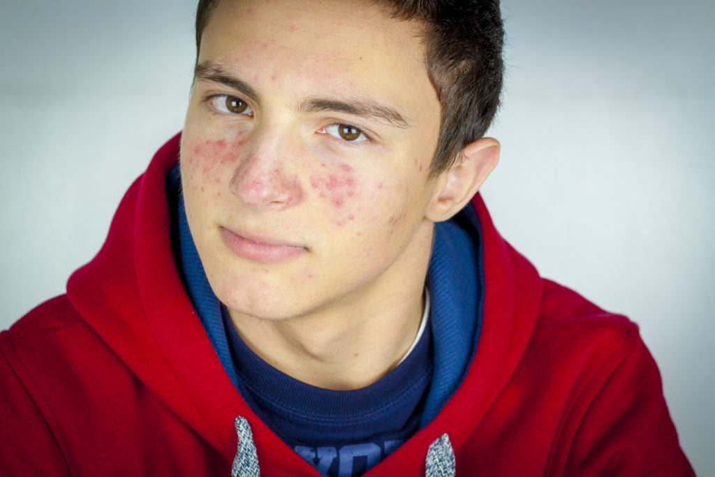 Why Do Teenagers Get Acne?