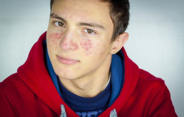 Portrait of teenage boy with acne