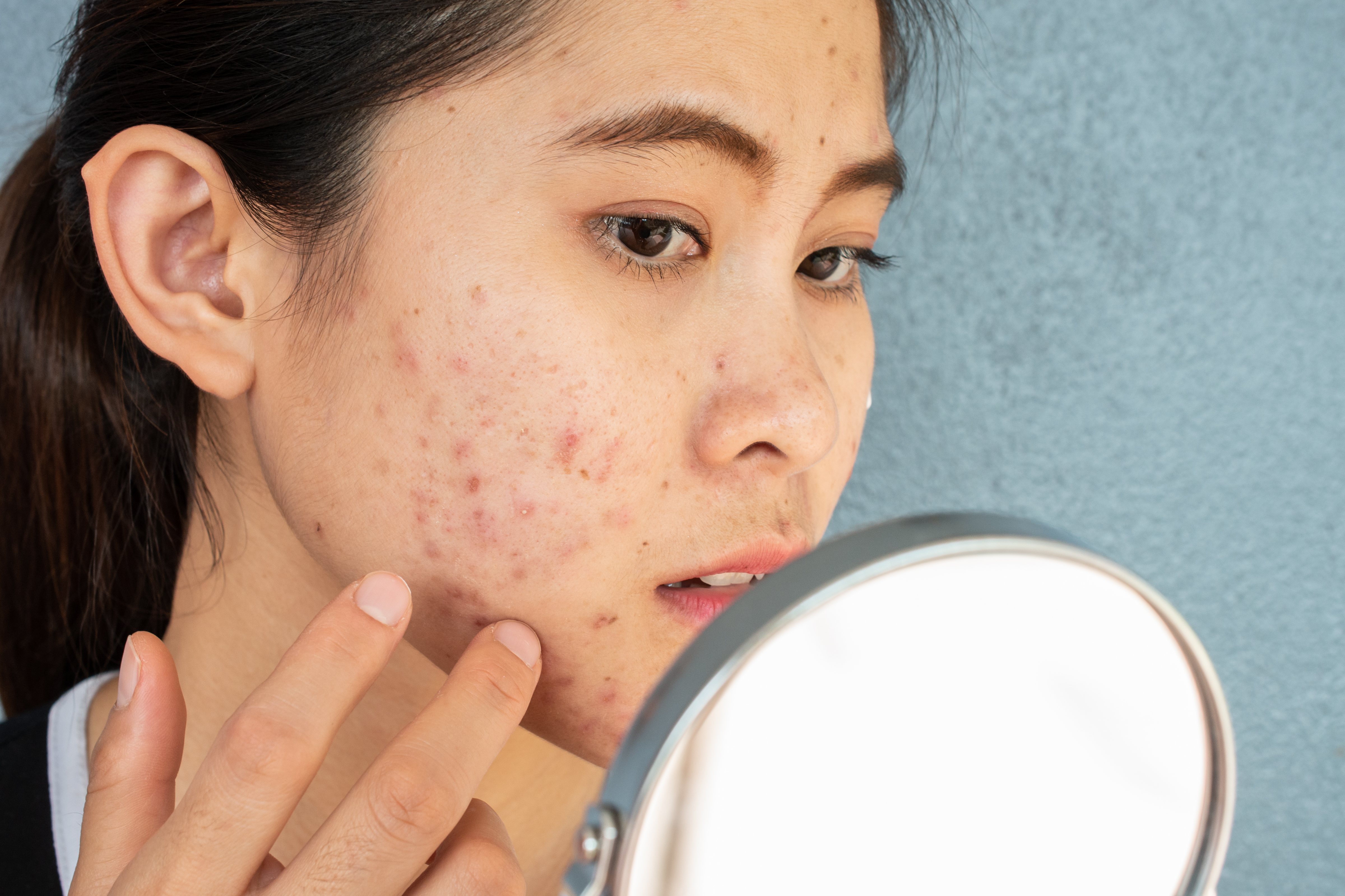 At What Age Does Acne Go Away?